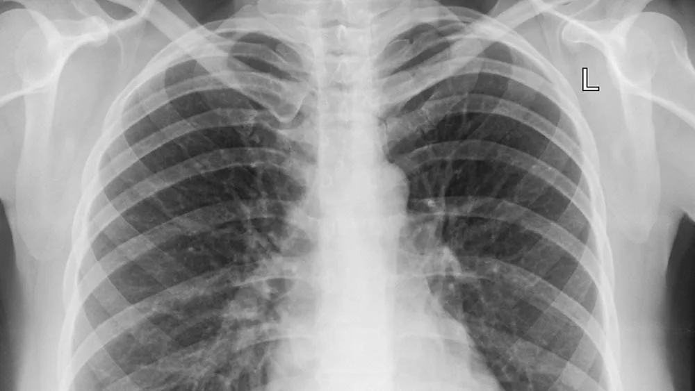 Casi 6 mil casos de neumonía en Salta: los pulmones en alerta roja