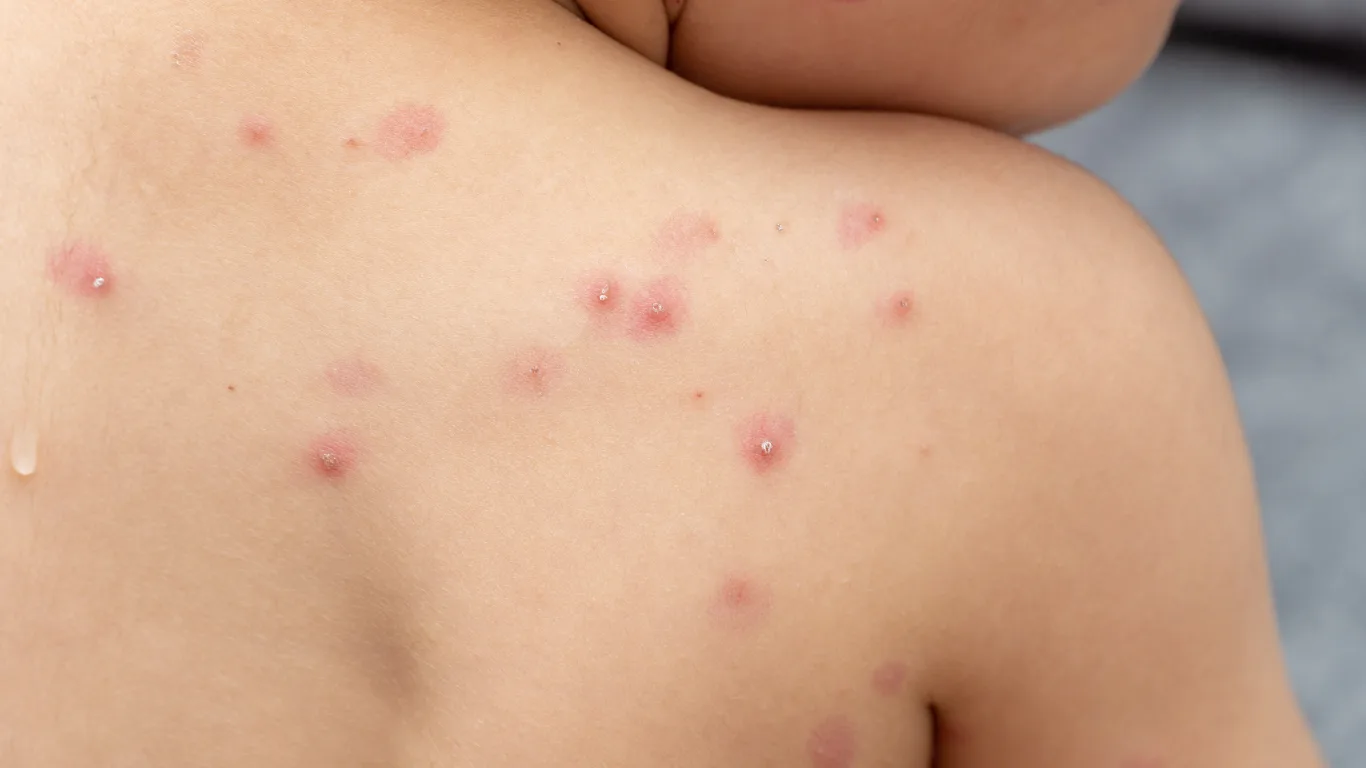 viruela del mono salud extrema controles en aeropuertos para frenar contagios