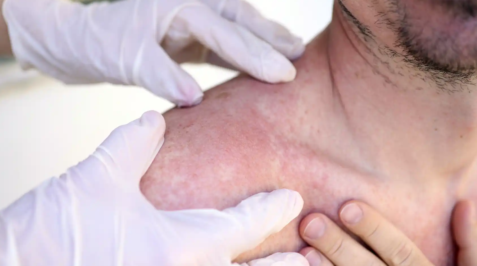 vaccimel la vacuna argentina que promete combatir el cancer de piel mas letal