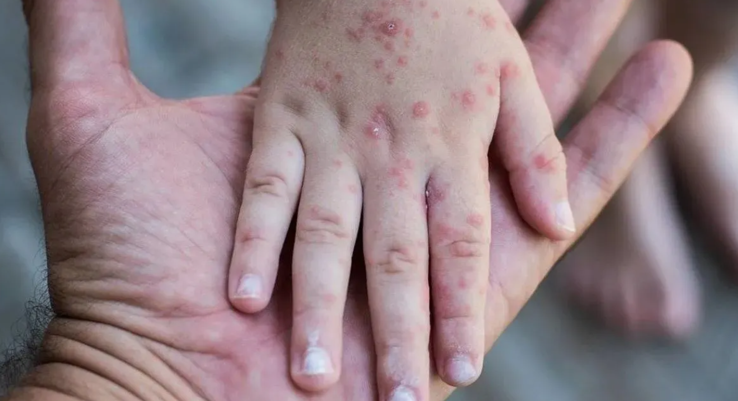 alerta epidemiologica por sarampion en el pais