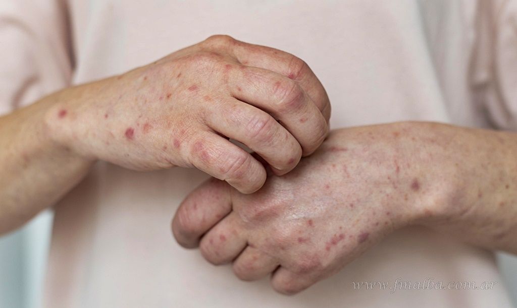 alerta por posibles casos de sarampion en salta los proximos 20 o 30 dias seran cruciales