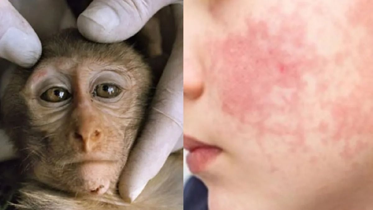 alerta mundial por viruela del mono cuantos casos hay en la argentina