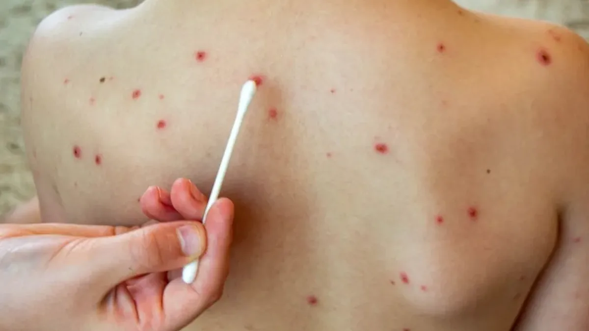 alerta epidemiologica en salta por la circulacion de cuatro viajeros con sarampion